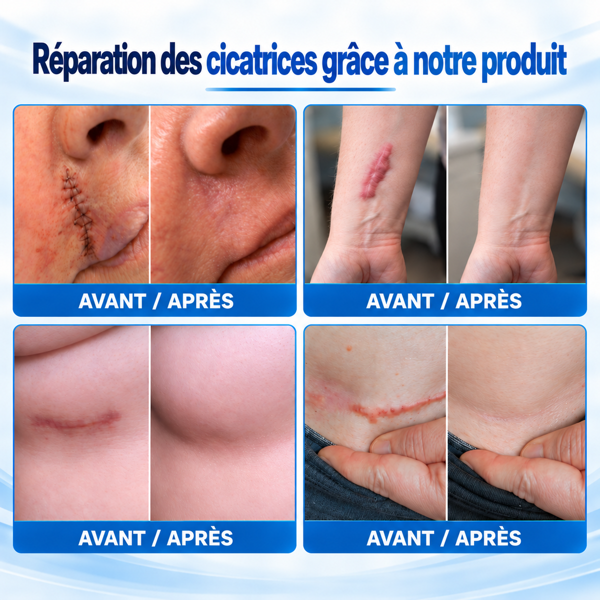 🇫🇷Dr.Fachmer® 🩹 Patch Réparateur Bio-Régénérant à Micro-Aiguilles pour Cicatrices – Soin Avancé au Collagène & Silicone
