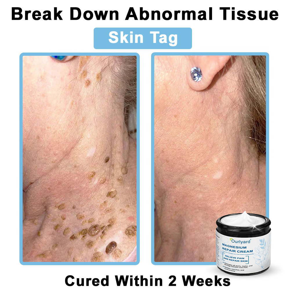 30%Discount✅Official Store: Ourlyard® Magnesium skin repair cream (Psoriasis Relief, Skin Repair, Even Tone, Acne and Dark Spot Treatment, Wart and Mole Removal)