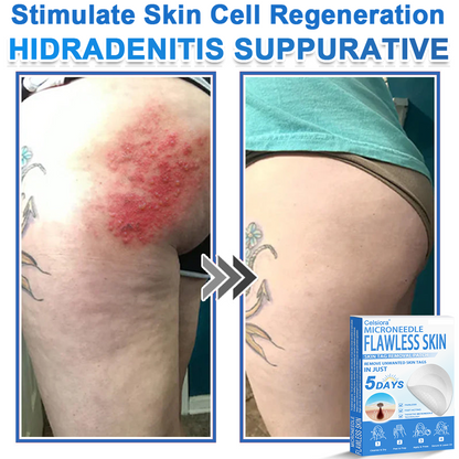 👩‍⚕️ Celsiora® 2-in-1 Microneedle & Hydrocolloid Patch | Raised Moles,Acne,  Flat Warts & Skin Tags Remover | Improves Wrinkles, Scars & Blemishes | Invisible Pimple Patches for Face & Body