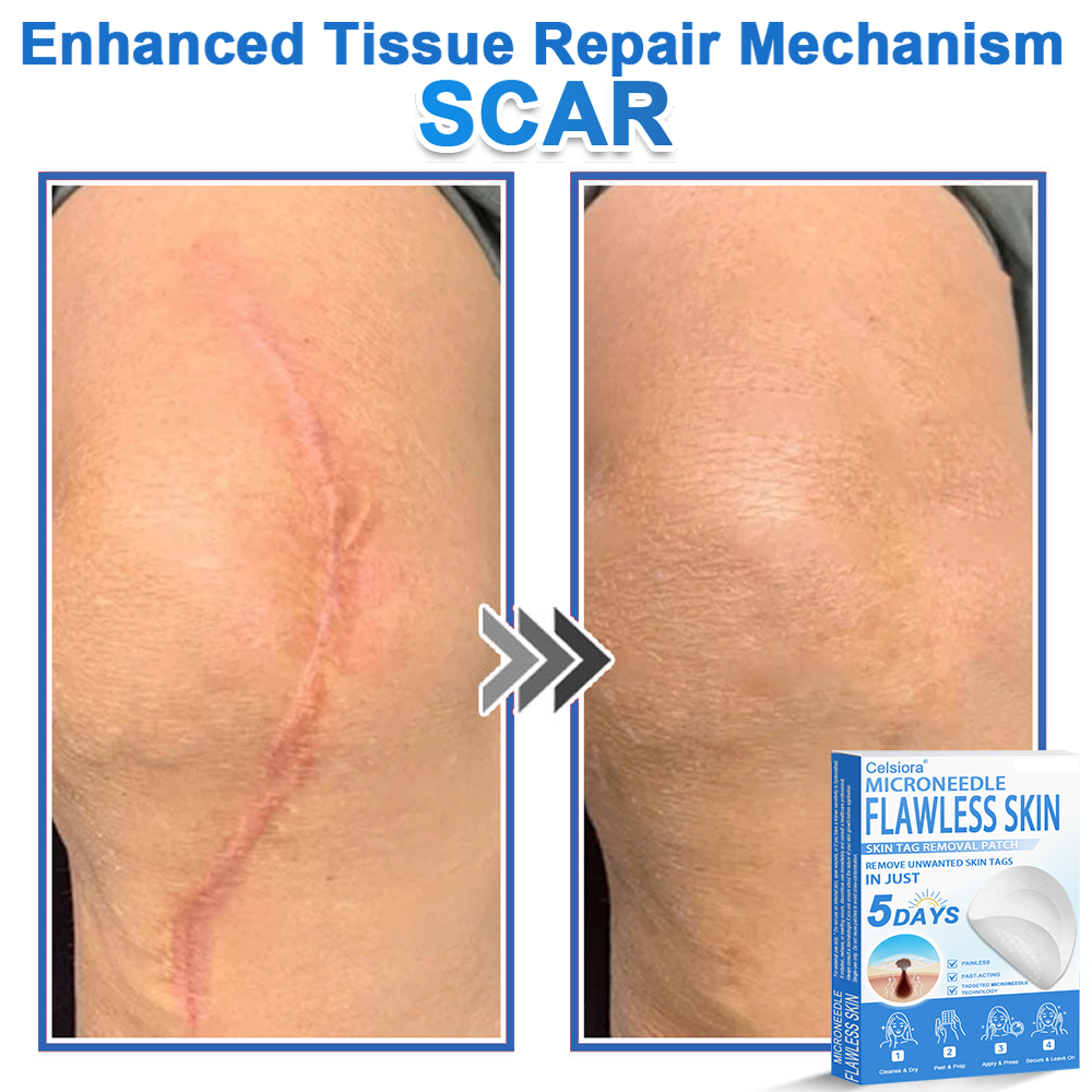 👩‍⚕️ Celsiora® 2-in-1 Microneedle & Hydrocolloid Patch | Raised Moles,Acne,  Flat Warts & Skin Tags Remover | Improves Wrinkles, Scars & Blemishes | Invisible Pimple Patches for Face & Body