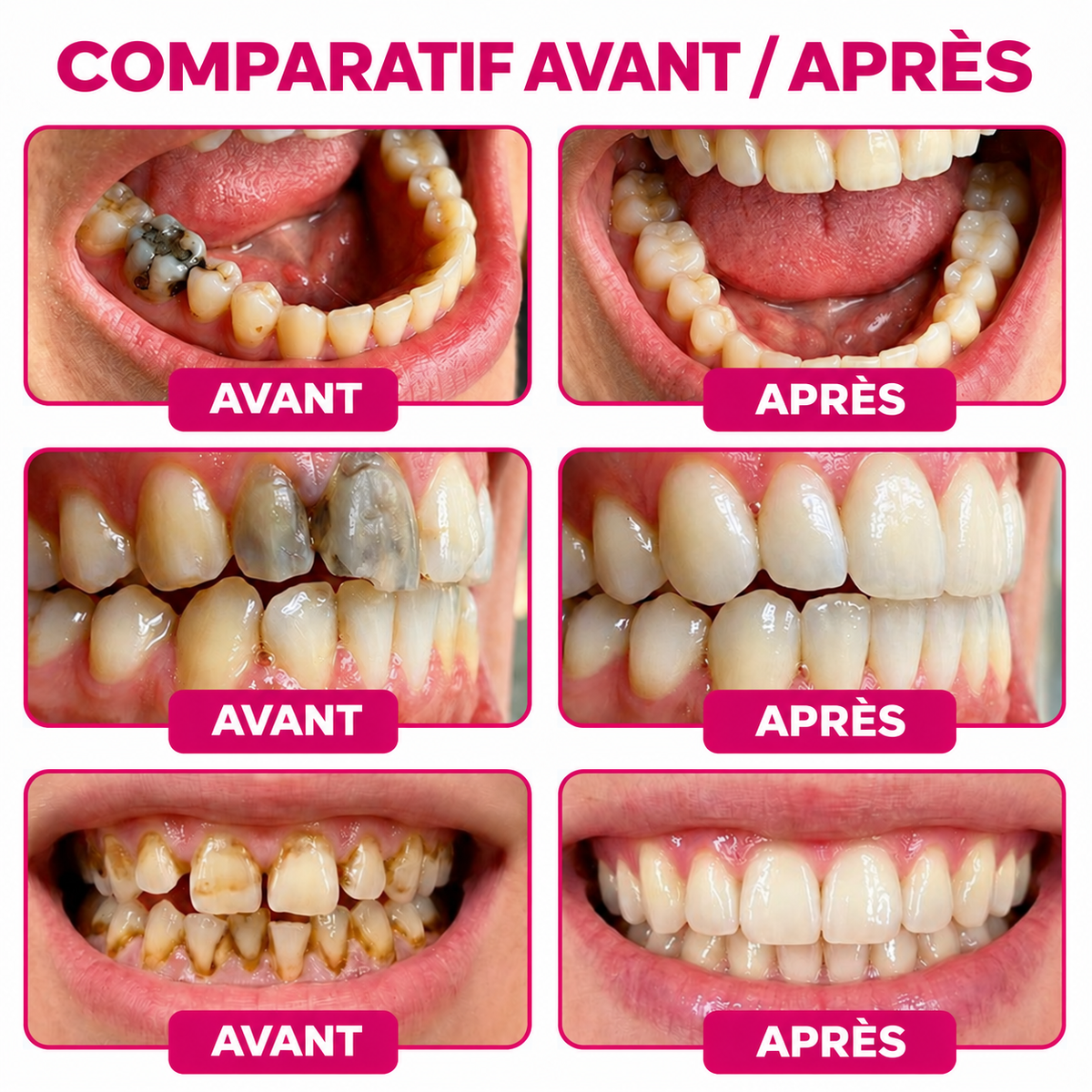 🤍 Rolimey® DenPerm – Gel de comblement naturel de l’émail pour réparer les caries