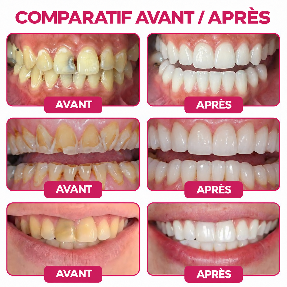 🤍 Rolimey® DenPerm – Gel de comblement naturel de l’émail pour réparer les caries