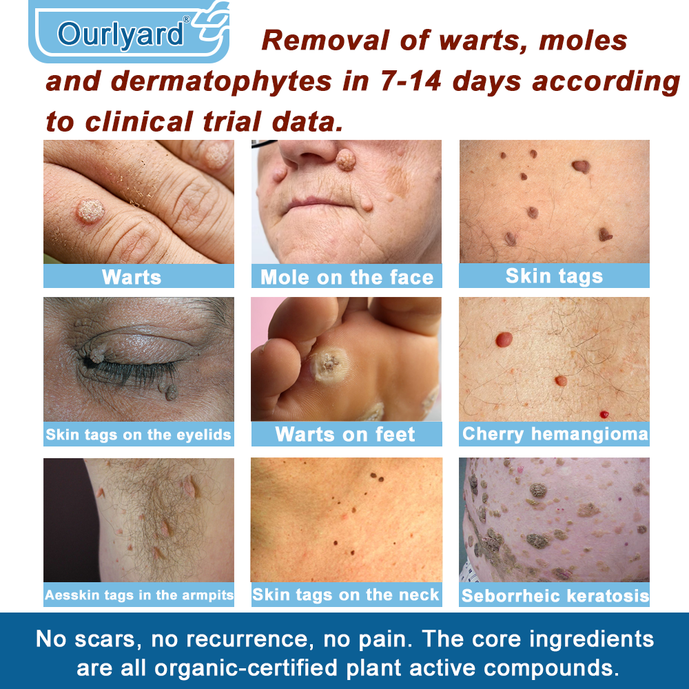 30%Discount✅Official Store: Ourlyard® Magnesium skin repair cream (Psoriasis Relief, Skin Repair, Even Tone, Acne and Dark Spot Treatment, Wart and Mole Removal)