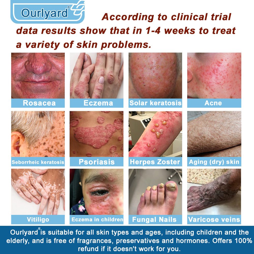 30%Discount✅Official Store: Ourlyard® Magnesium skin repair cream (Psoriasis Relief, Skin Repair, Even Tone, Acne and Dark Spot Treatment, Wart and Mole Removal)