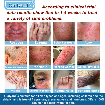 30%Discount✅Official Store: Ourlyard® Magnesium skin repair cream (Psoriasis Relief, Skin Repair, Even Tone, Acne and Dark Spot Treatment, Wart and Mole Removal)