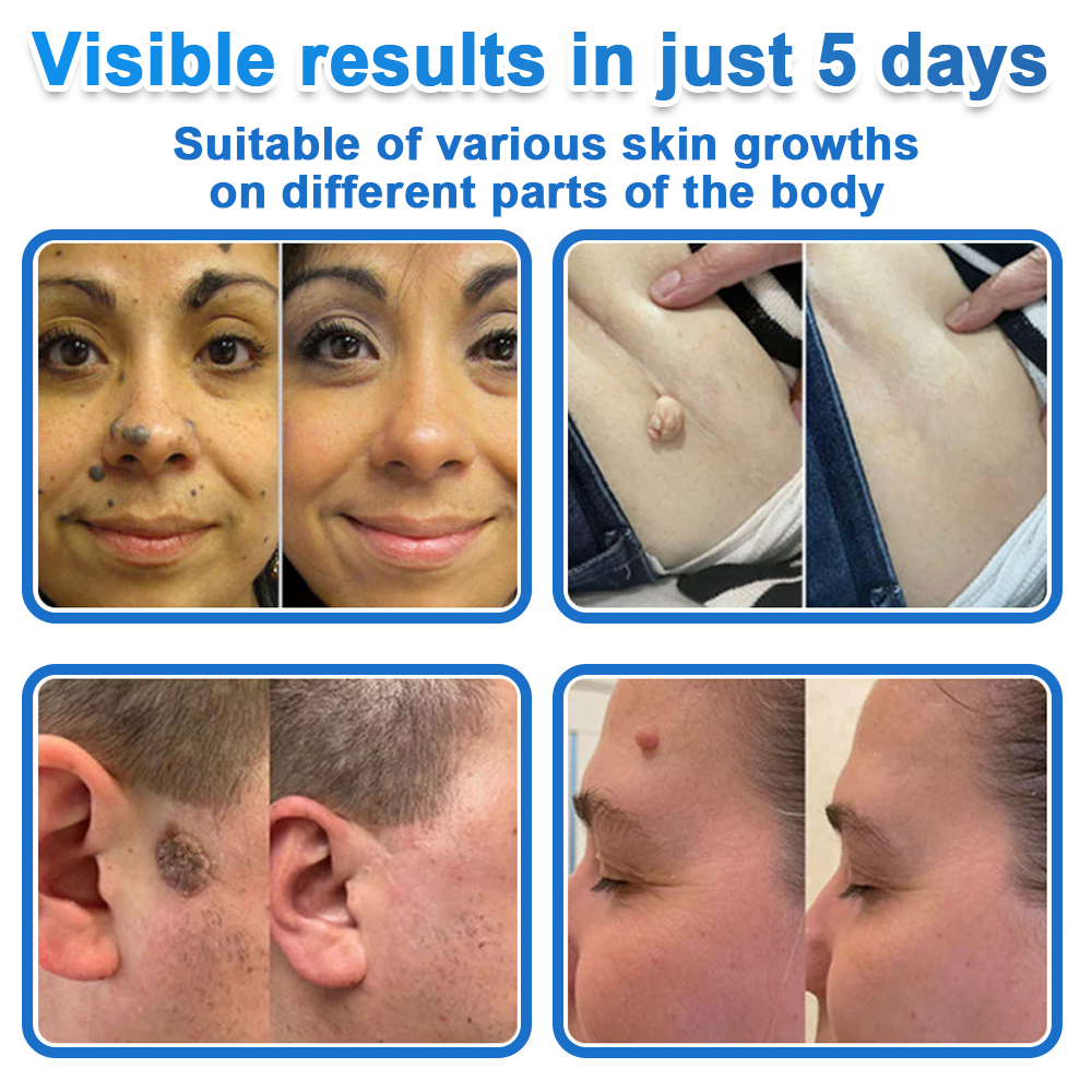 ✅Celsiora® 2-in-1 Microneedle & Hydrocolloid Patch | Raised Moles,Acne,  Flat Warts & Skin Tags Remover | Improves Wrinkles, Scars & Blemishes | Invisible Pimple Patches for Face & Body