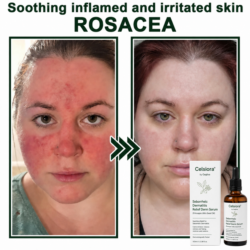 🍁Celsiora® Seborrheic Dermatitis Relief Derm Serum