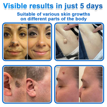 👩‍⚕️ Celsiora® 2-in-1 Microneedle & Hydrocolloid Patch | Raised Moles,Acne,  Flat Warts & Skin Tags Remover | Improves Wrinkles, Scars & Blemishes | Invisible Pimple Patches for Face & Body