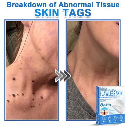 👩‍⚕️ Celsiora® 2-in-1 Microneedle & Hydrocolloid Patch | Raised Moles,Acne,  Flat Warts & Skin Tags Remover | Improves Wrinkles, Scars & Blemishes | Invisible Pimple Patches for Face & Body
