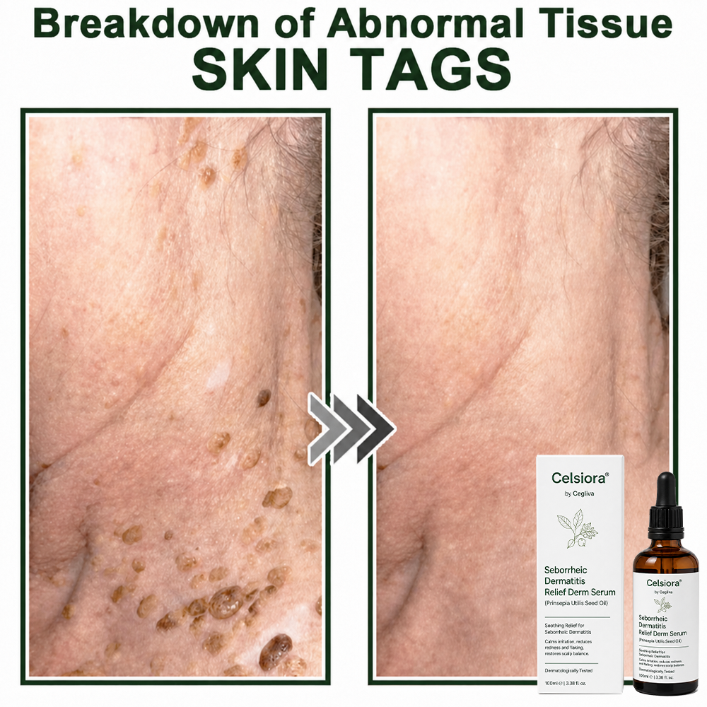 🍁Celsiora® Seborrheic Dermatitis Relief Derm Serum