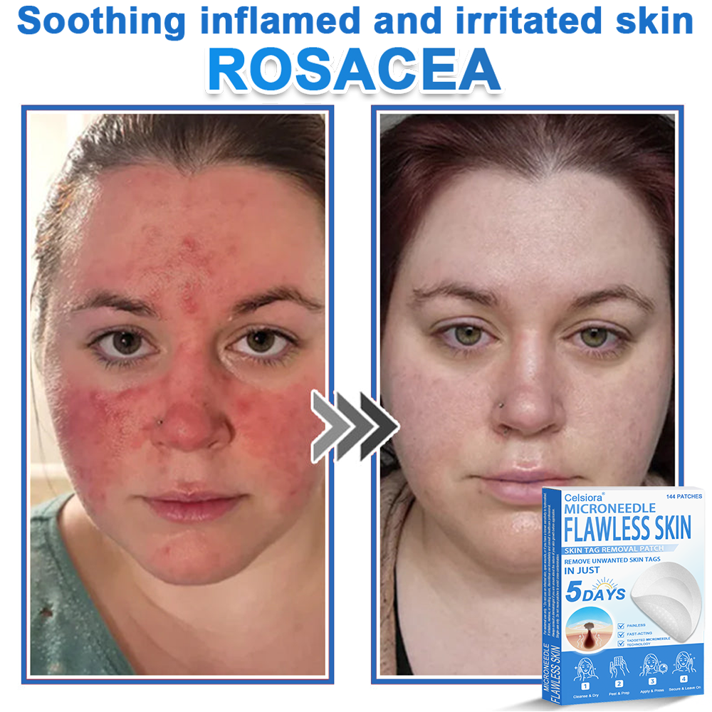 ✅Celsiora® 2-in-1 Microneedle & Hydrocolloid Patch | Raised Moles,Acne,  Flat Warts & Skin Tags Remover | Improves Wrinkles, Scars & Blemishes | Invisible Pimple Patches for Face & Body