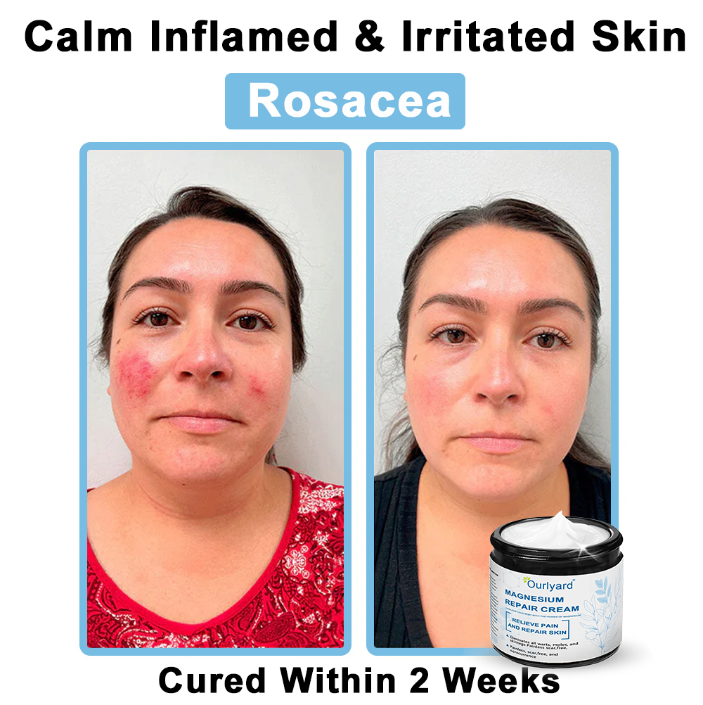 30%Discount✅Official Store: Ourlyard® Magnesium skin repair cream (Psoriasis Relief, Skin Repair, Even Tone, Acne and Dark Spot Treatment, Wart and Mole Removal)