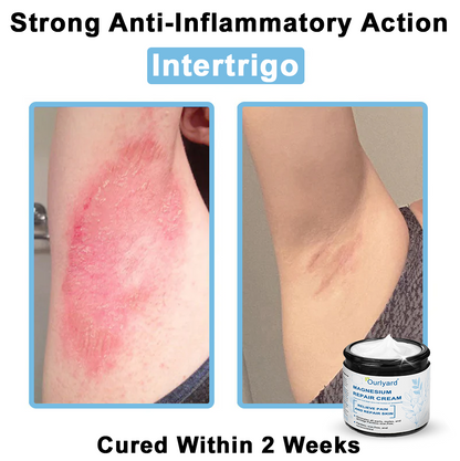 30%Discount✅Official Store: Ourlyard® Magnesium skin repair cream (Psoriasis Relief, Skin Repair, Even Tone, Acne and Dark Spot Treatment, Wart and Mole Removal)