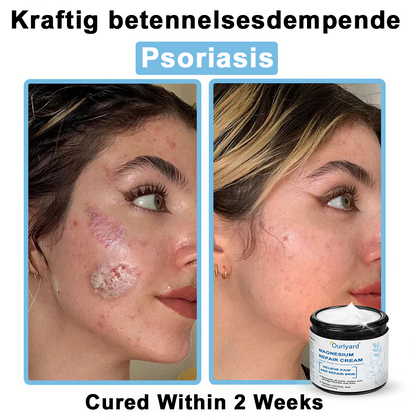 30%Discount✅Official Store: Ourlyard® Magnesium skin repair cream (Psoriasis Relief, Skin Repair, Even Tone, Acne and Dark Spot Treatment, Wart and Mole Removal)
