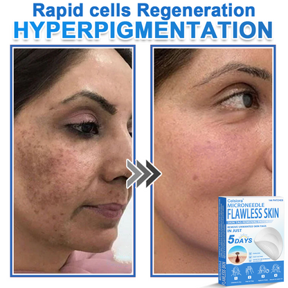 ✅Celsiora® 2-in-1 Microneedle & Hydrocolloid Patch | Raised Moles,Acne,  Flat Warts & Skin Tags Remover | Improves Wrinkles, Scars & Blemishes | Invisible Pimple Patches for Face & Body