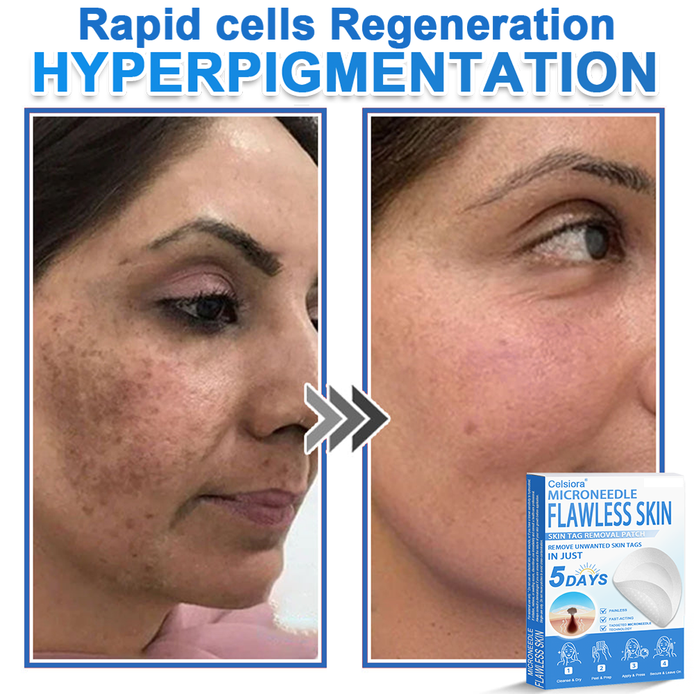 👩‍⚕️ Celsiora® 2-in-1 Microneedle & Hydrocolloid Patch | Raised Moles,Acne,  Flat Warts & Skin Tags Remover | Improves Wrinkles, Scars & Blemishes | Invisible Pimple Patches for Face & Body