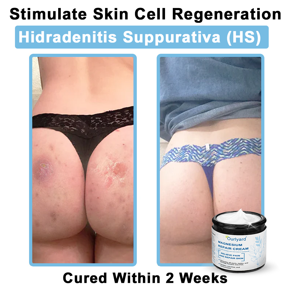30%Discount✅Official Store: Ourlyard® Magnesium skin repair cream (Psoriasis Relief, Skin Repair, Even Tone, Acne and Dark Spot Treatment, Wart and Mole Removal)