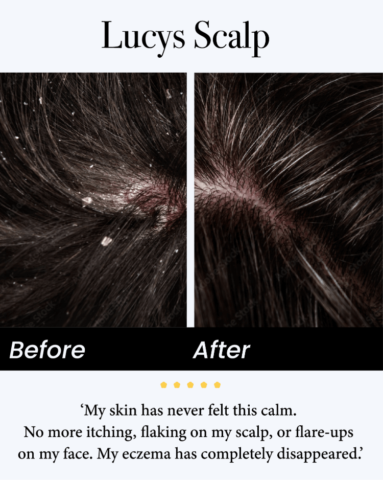 🍁Celsiora® Seborrheic Dermatitis Relief Derm Serum
