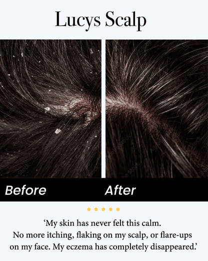 🍁Celsiora® Seborrheic Dermatitis Relief Derm Serum