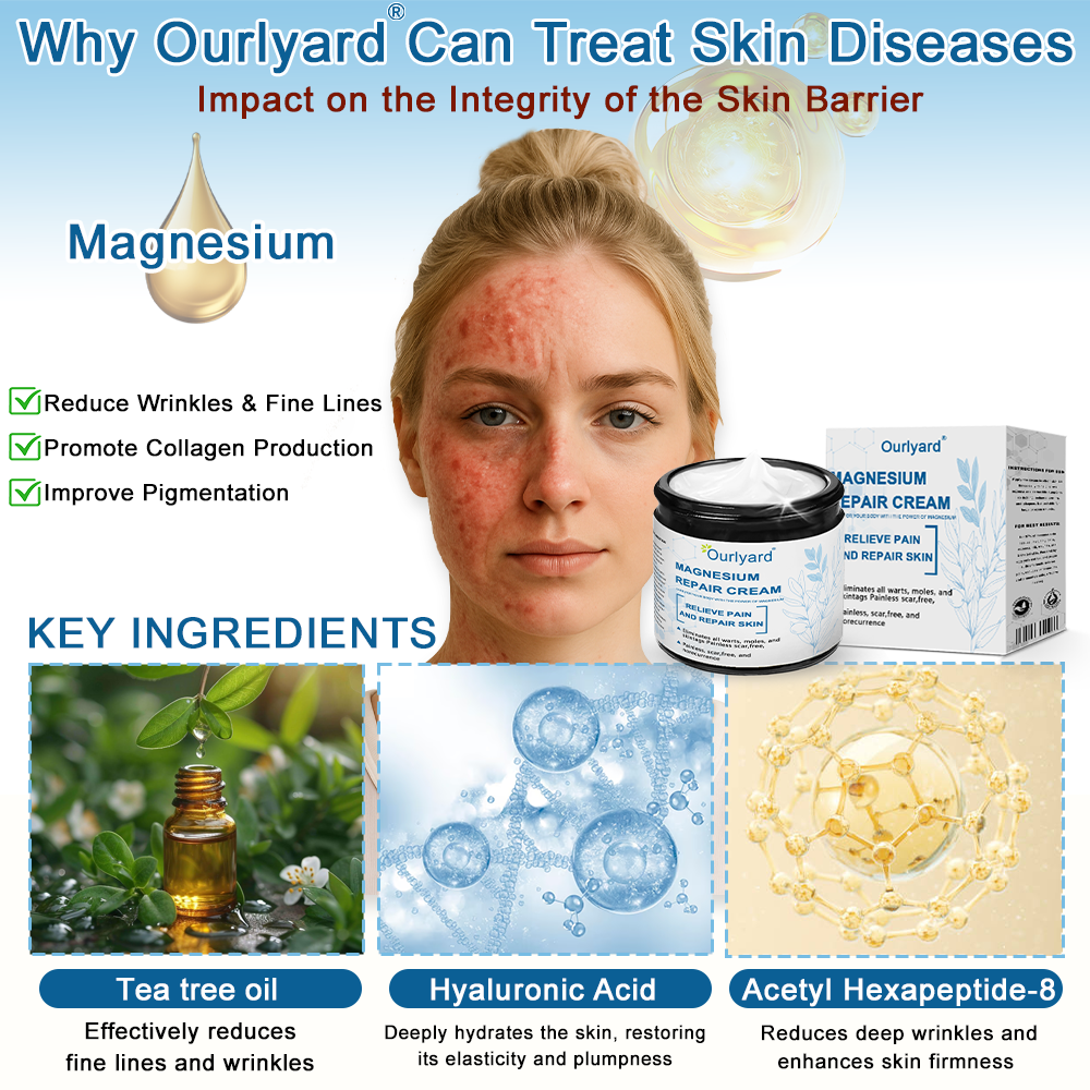 30%Discount✅Official Store: Ourlyard® Magnesium skin repair cream (Psoriasis Relief, Skin Repair, Even Tone, Acne and Dark Spot Treatment, Wart and Mole Removal)